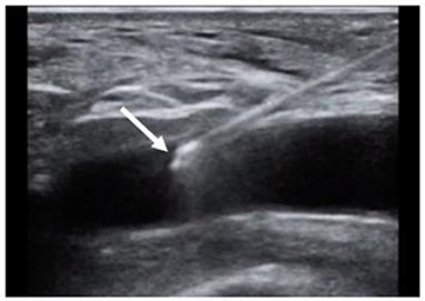 Transcatheter Aortic Valve Implantation: All Transfemoral? Update on Peripheral Vascular Access and Closure